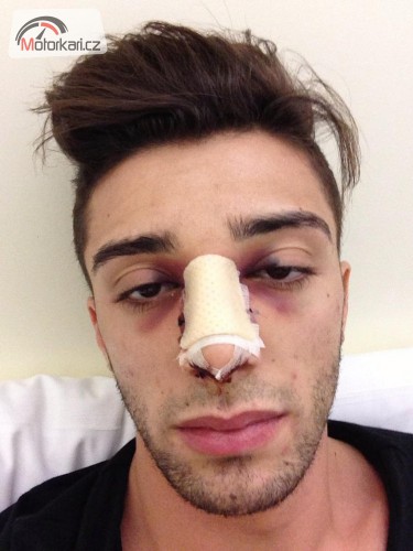 Andrea Iannone úspěšně operován na nose
